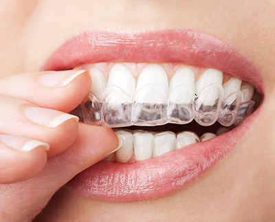 Invisalign® Dentist